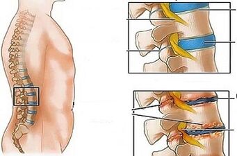 Las razones para el desarrollo de la osteocondrosis lumbar