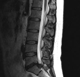 Opciones de diagnóstico para la osteocondrosis lumbar
