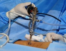 Tratamiento quirúrgico de la osteocondrosis lumbar
