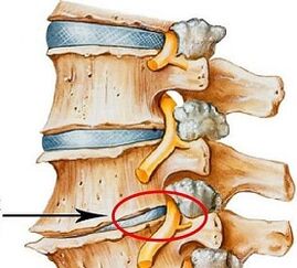 ¿Por qué es la osteocondrosis lumbar