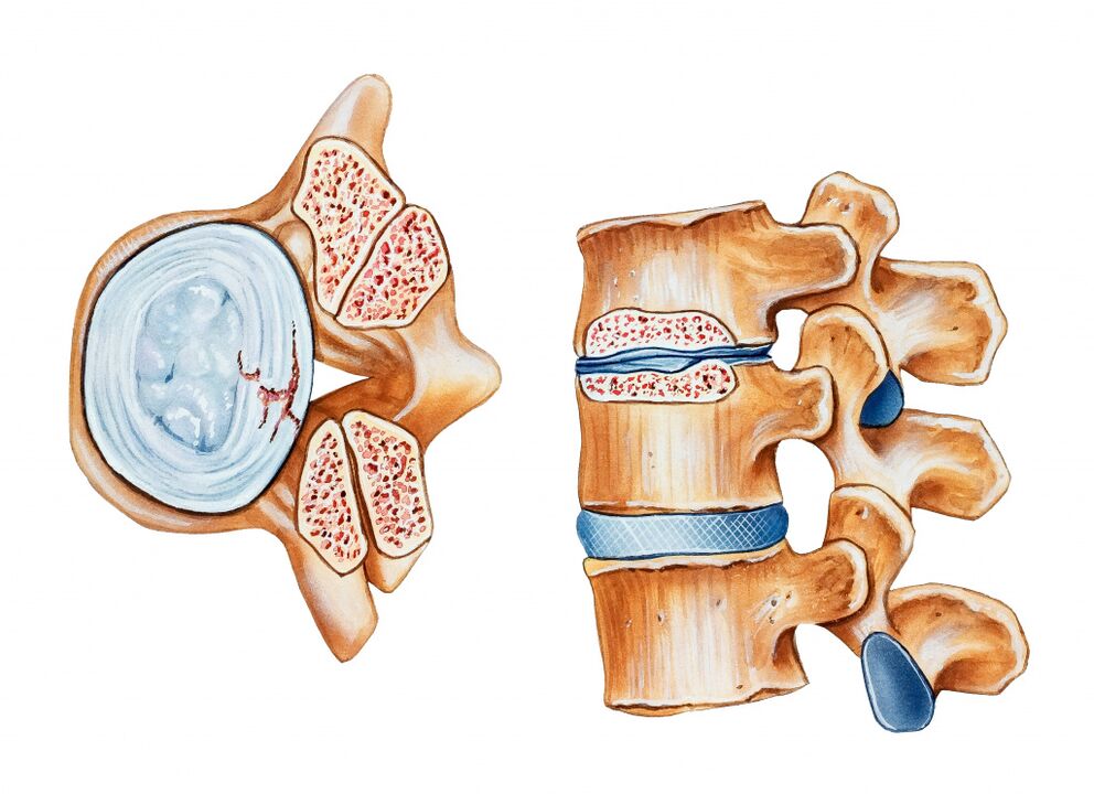 La osteocondrosis de la región cervical conduce a la destrucción de los discos intervertebrales