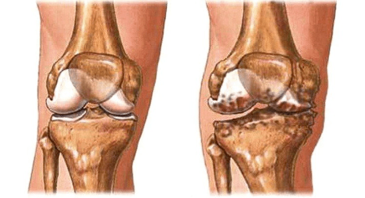 Articulación sana y artrosis de la articulación de la rodilla