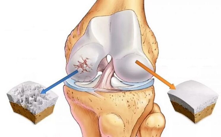 Cartílago saludable y artrosis de la articulación