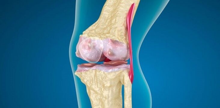 Daño a la articulación de la rodilla por artrosis
