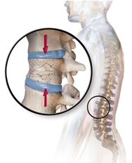 La osteoporosis provoca dolor de espalda en la parte baja de la espalda