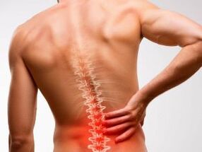 dolor lumbar debido a la osteocondrosis